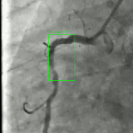 Angiography Analysis Tool